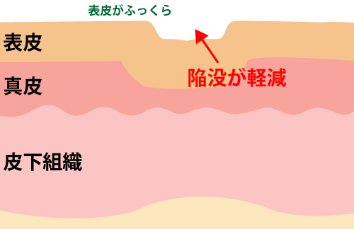 陥没量が軽減